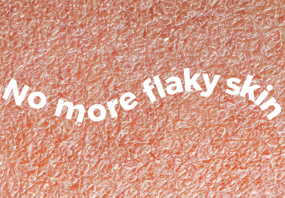How to deal with dry, flaky skin this winter 