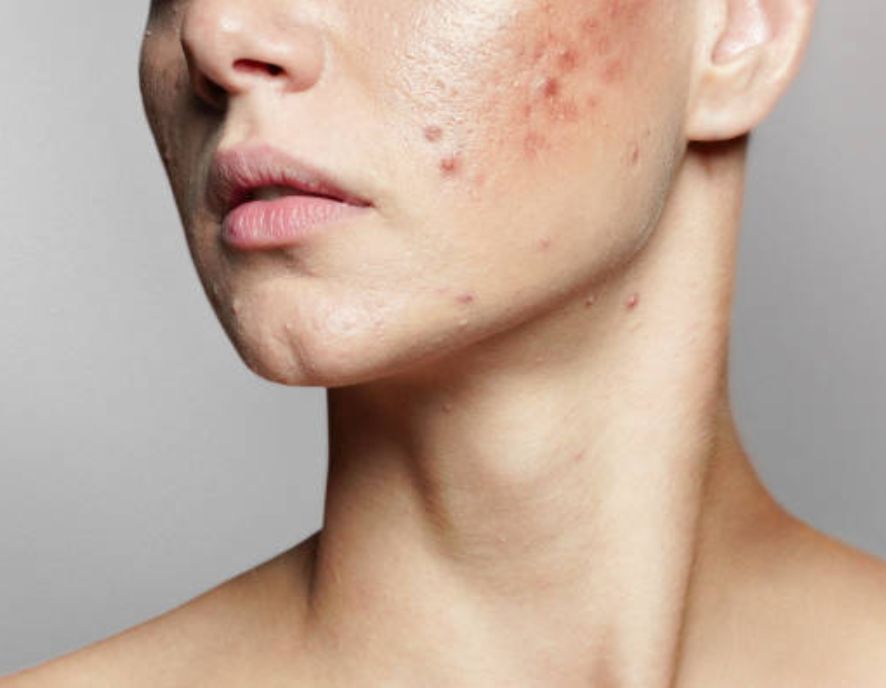 How to treat acne holistically