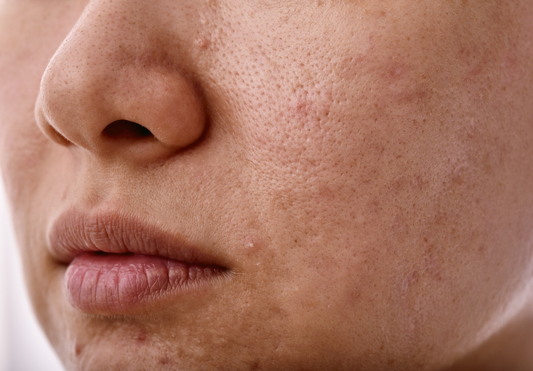Why you should care about your skin’s microbiome