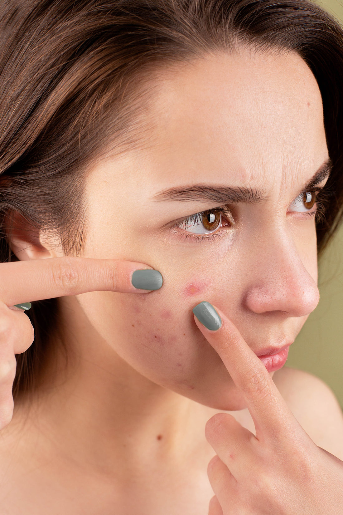 How to treat acne holistically